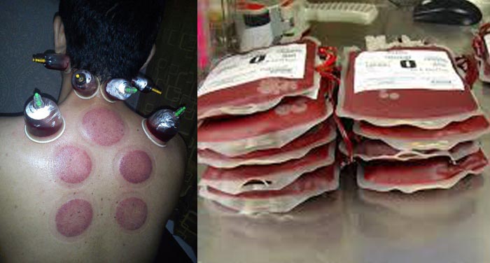 1-hijama-vs-blood-donation