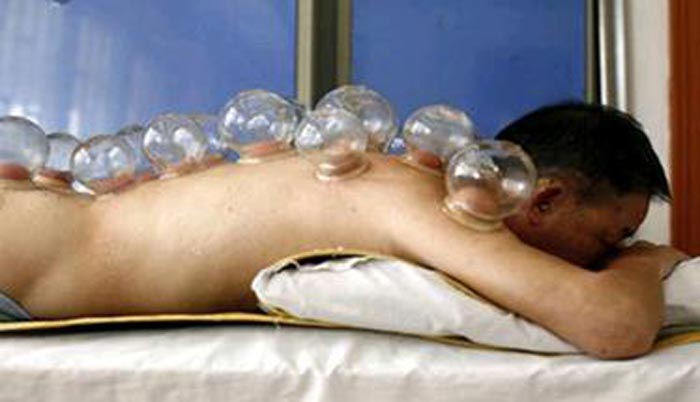 2-hijama-cupping-blood-picture